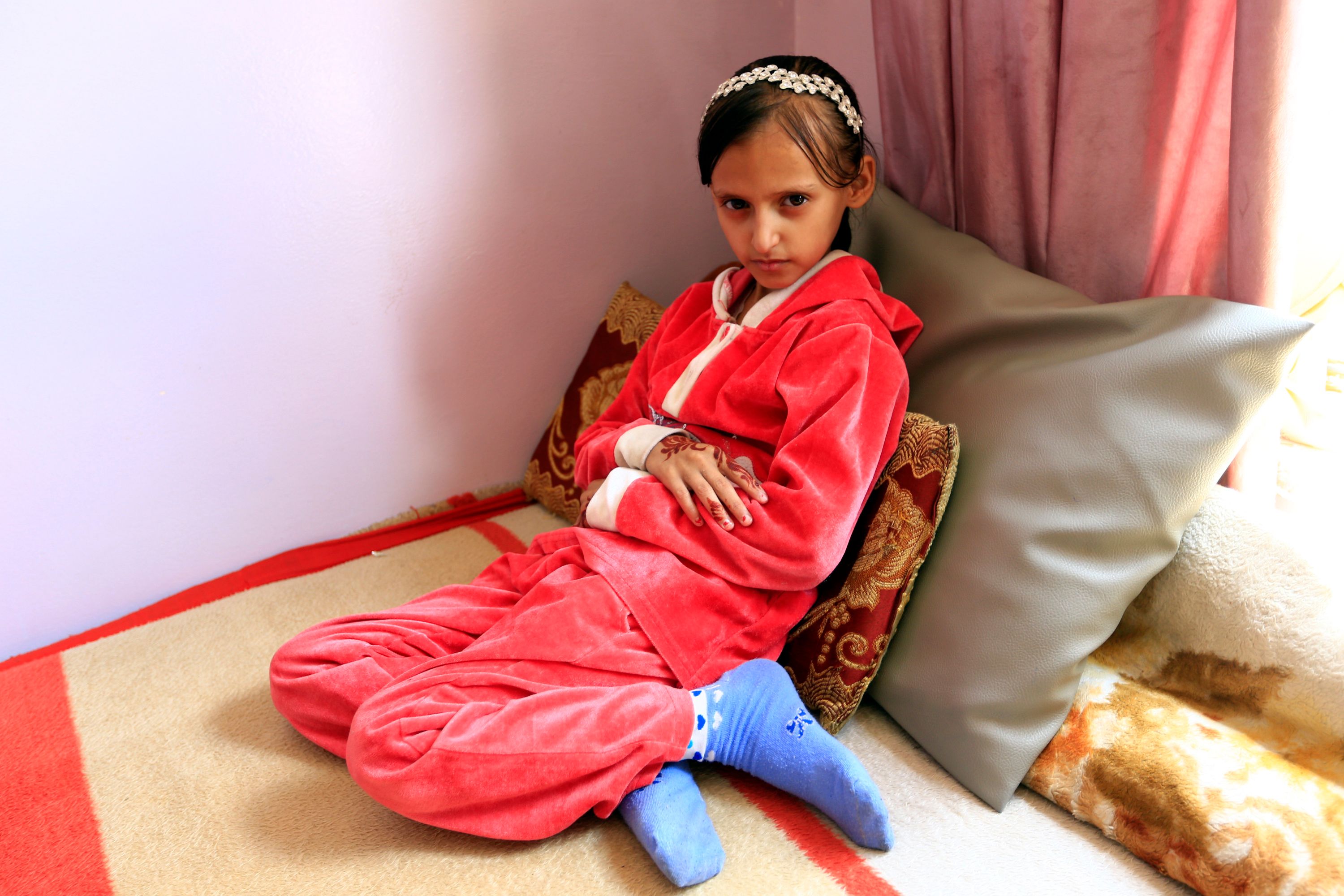 营养不良的也门儿童