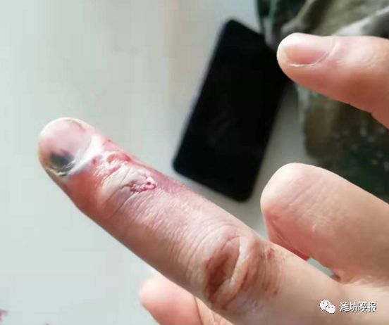 左手中指受伤包扎图片图片