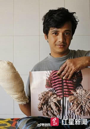 触目惊心!双手呈树枝状,孟加拉国树人手术3年后疾病复发
