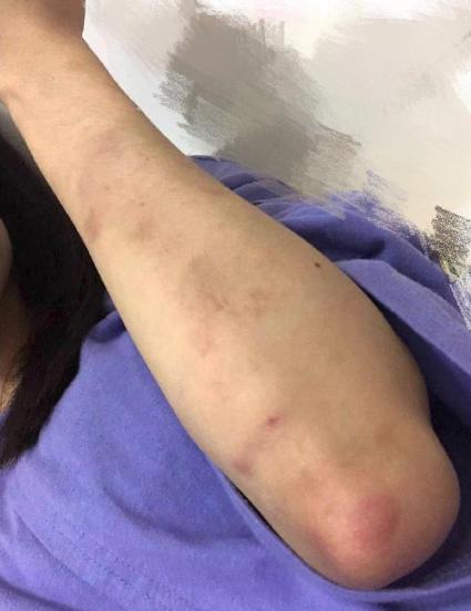 snh48成员自曝被好朋友殴打,扯着头发撞头扇脸,晒照片伤痕骇人