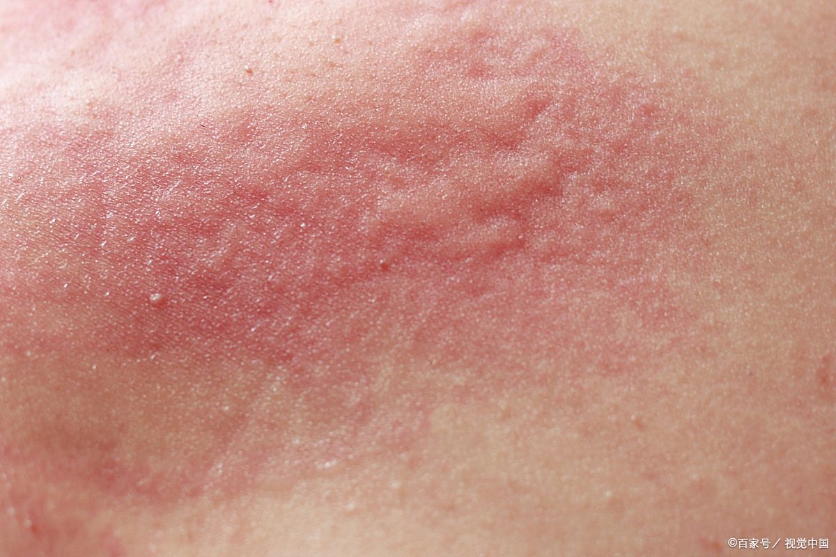 夏季皮炎的症状.