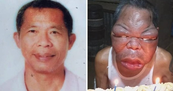 一切就从鼻窦炎开始 男脸部肿大3倍双眼惨失明