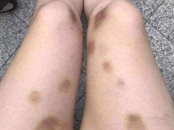 大学同学发现自己身上淤青,去到医院检查,原来是这个疾病