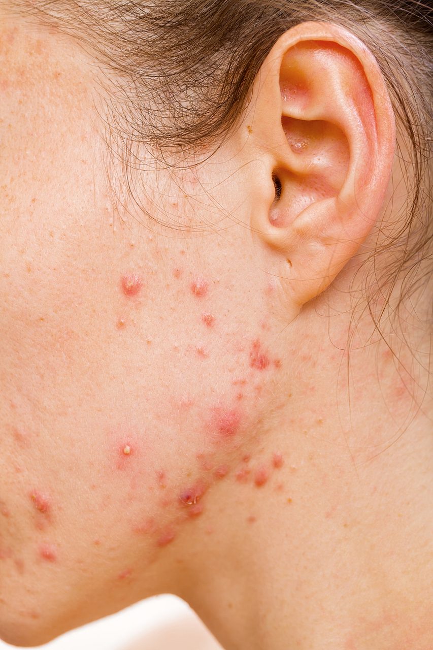 淋巴痘 #红蓝光祛痘#  淋巴痘是一种常见的皮肤问题,也被称为淋巴管炎