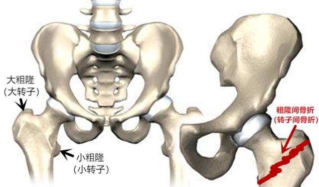 股骨粗隆间的位置图图片