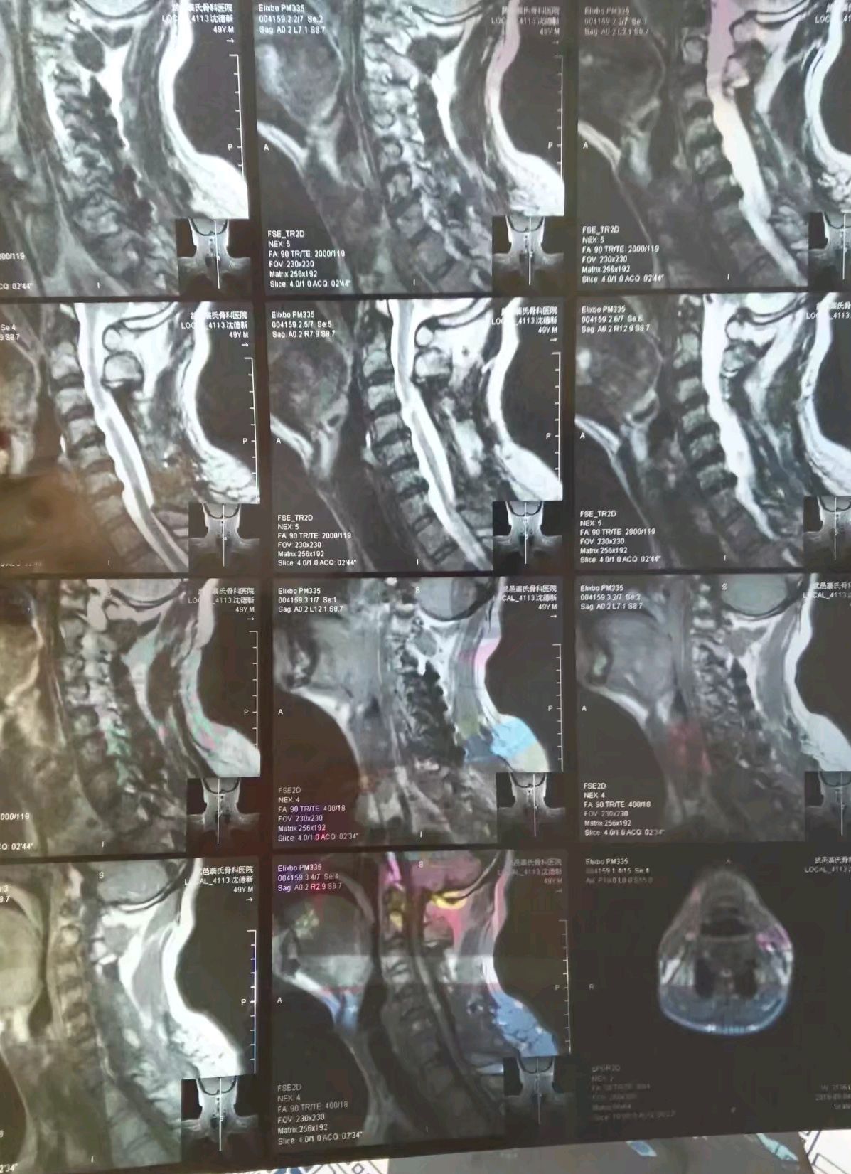 外伤所致颈椎骨折脊髓损伤会瘫痪嘛?
