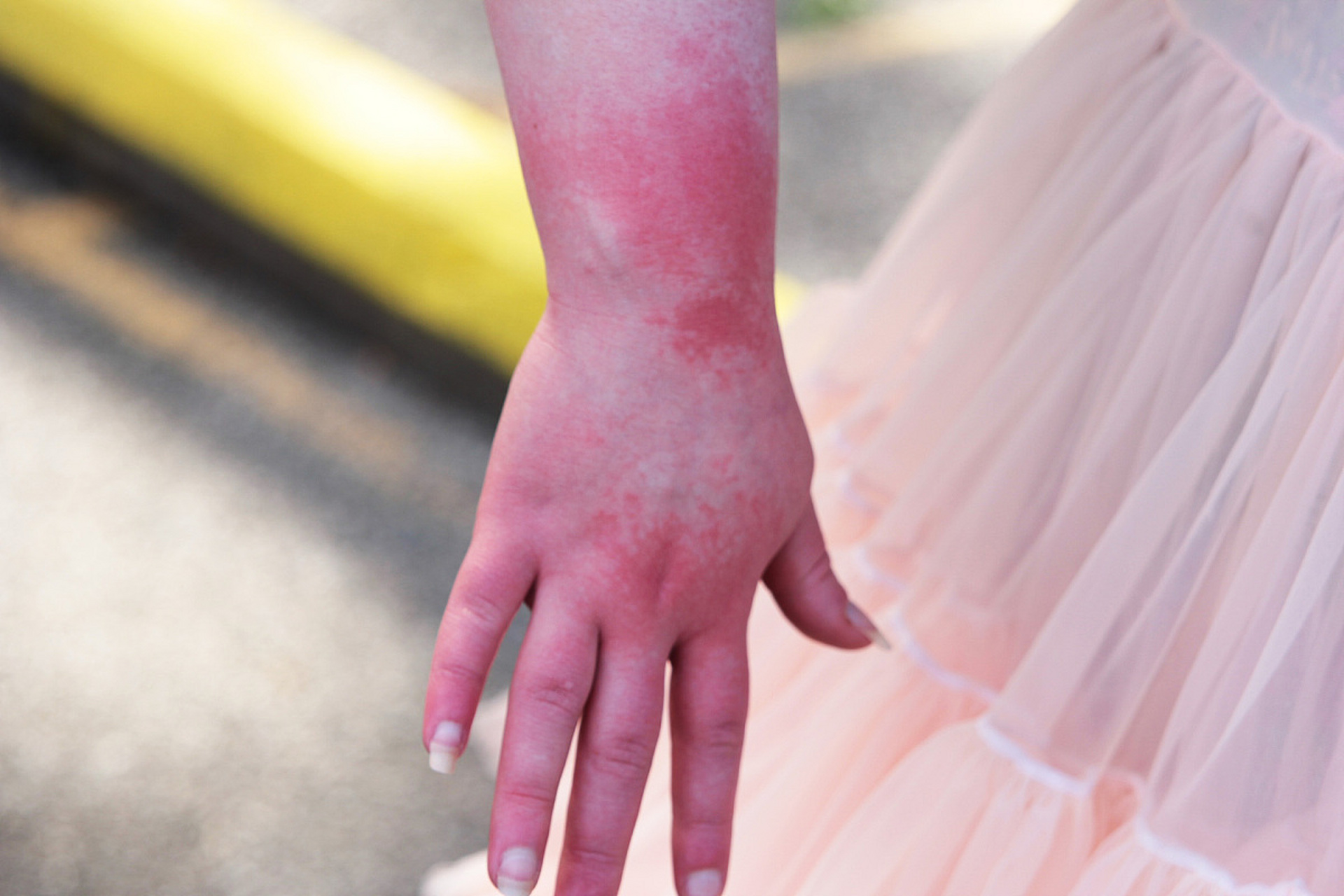 儿童烫伤,牢记5个字,将伤害降到最低!