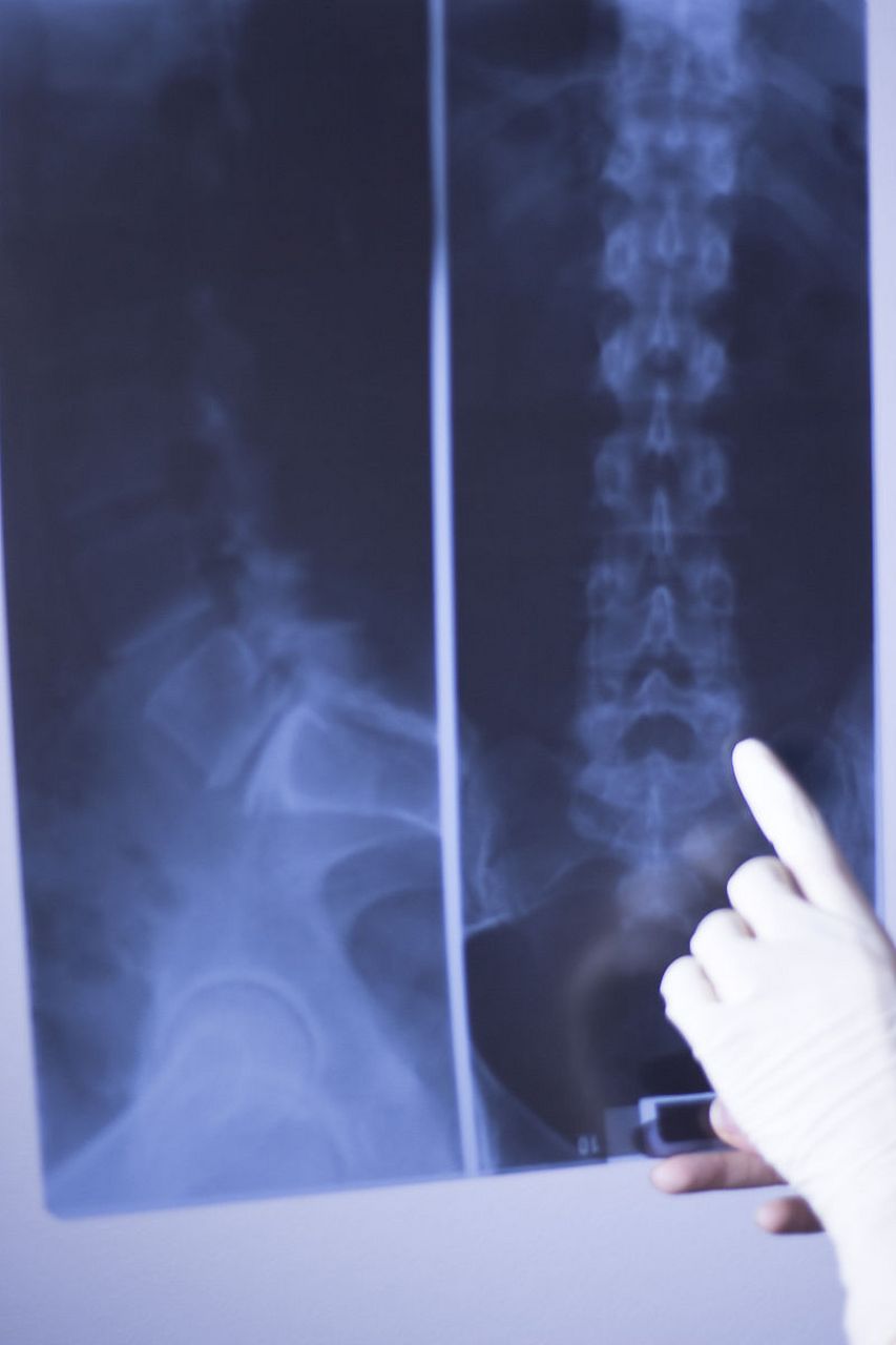 以体启身康健体魄#  尾骨骨折容易出现疼痛,肿胀,麻木,活动障碍的