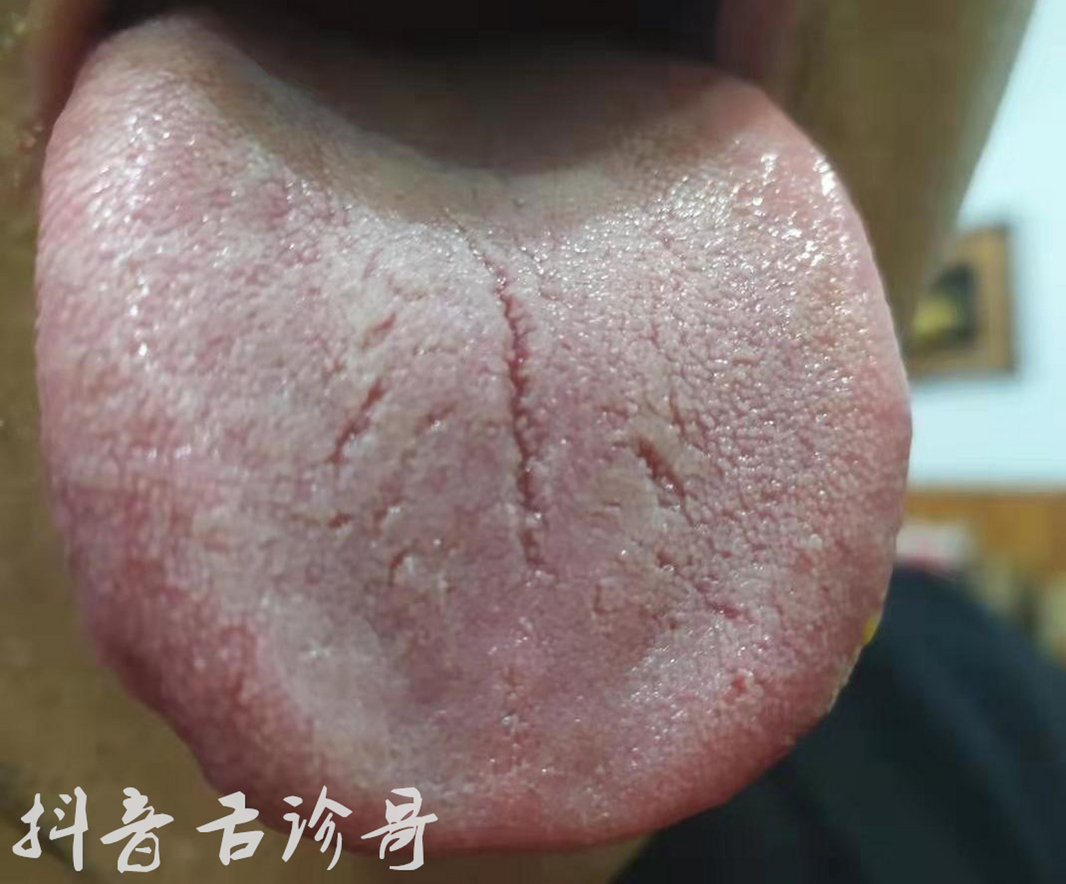 舌诊哥每天选取一些直观明显素材的舌头,就希望喜欢的朋友,每天都有新