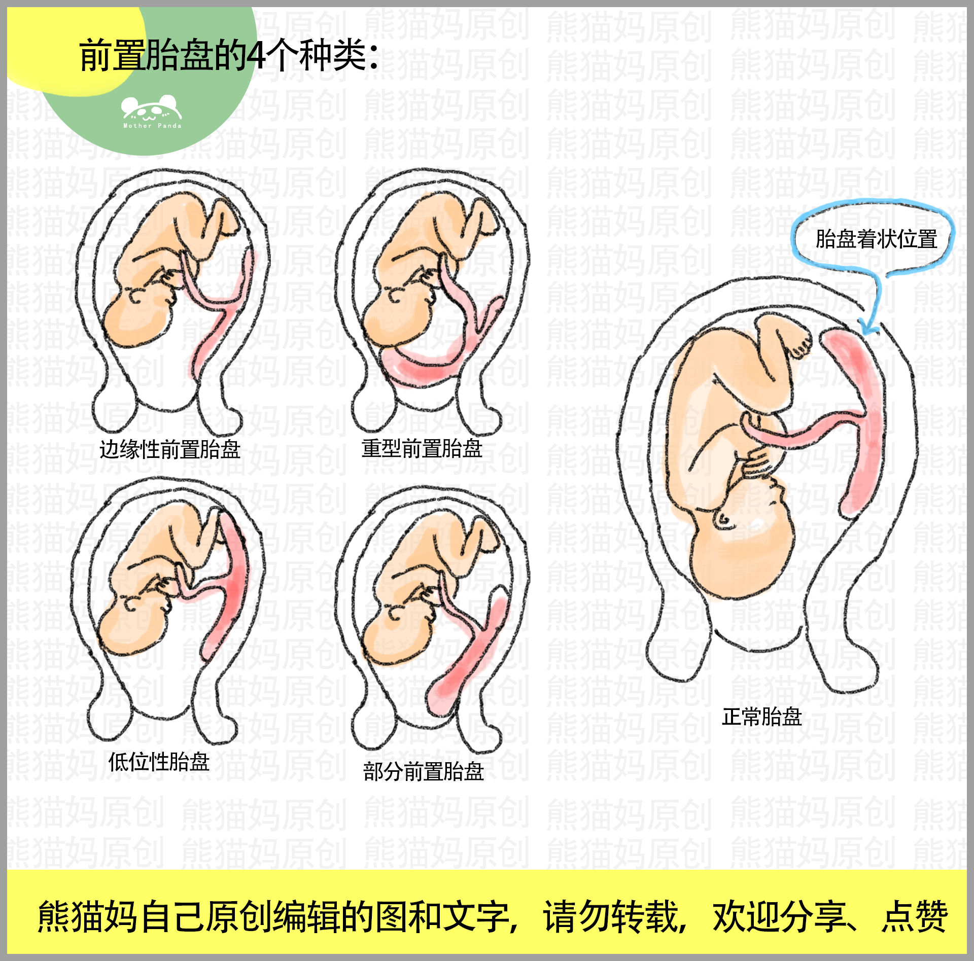 胎位不正11类型图:头先露,臀先露,横产式,斜产式,宝妈
