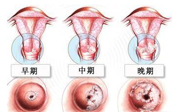 hpv照片症状 女性图片