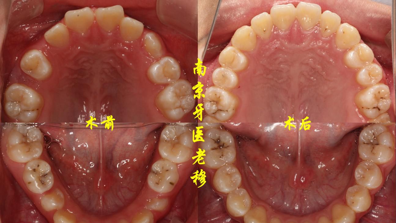 牙龈萎缩怎么办?