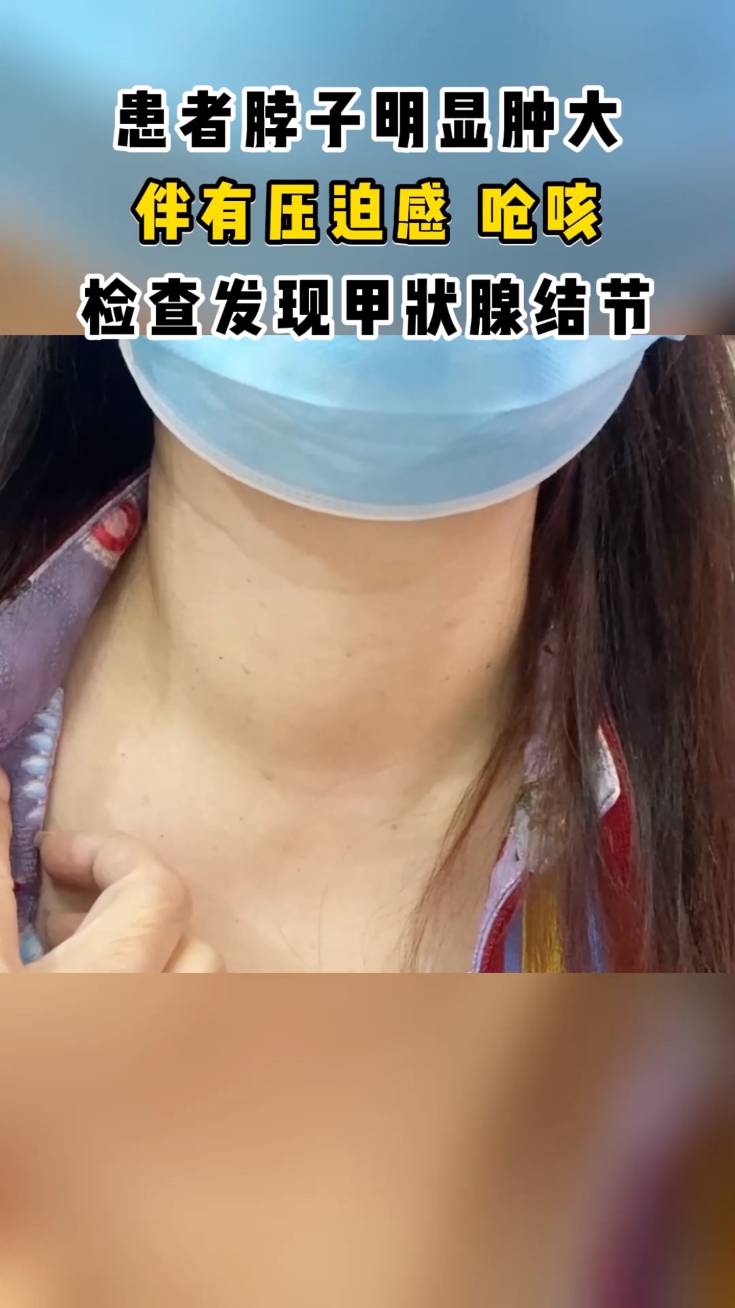 甲狀腺劉女士脖子明顯腫大嗓子經常嗆咳伴有壓迫感檢查發現甲狀腺結節