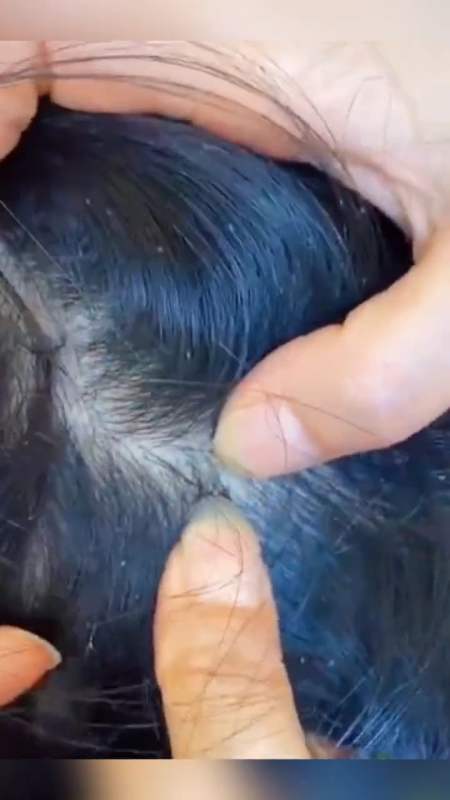 两孩子给婆婆带的,三个月没洗头没洗澡,头上都长虱子了,真的好无语啊