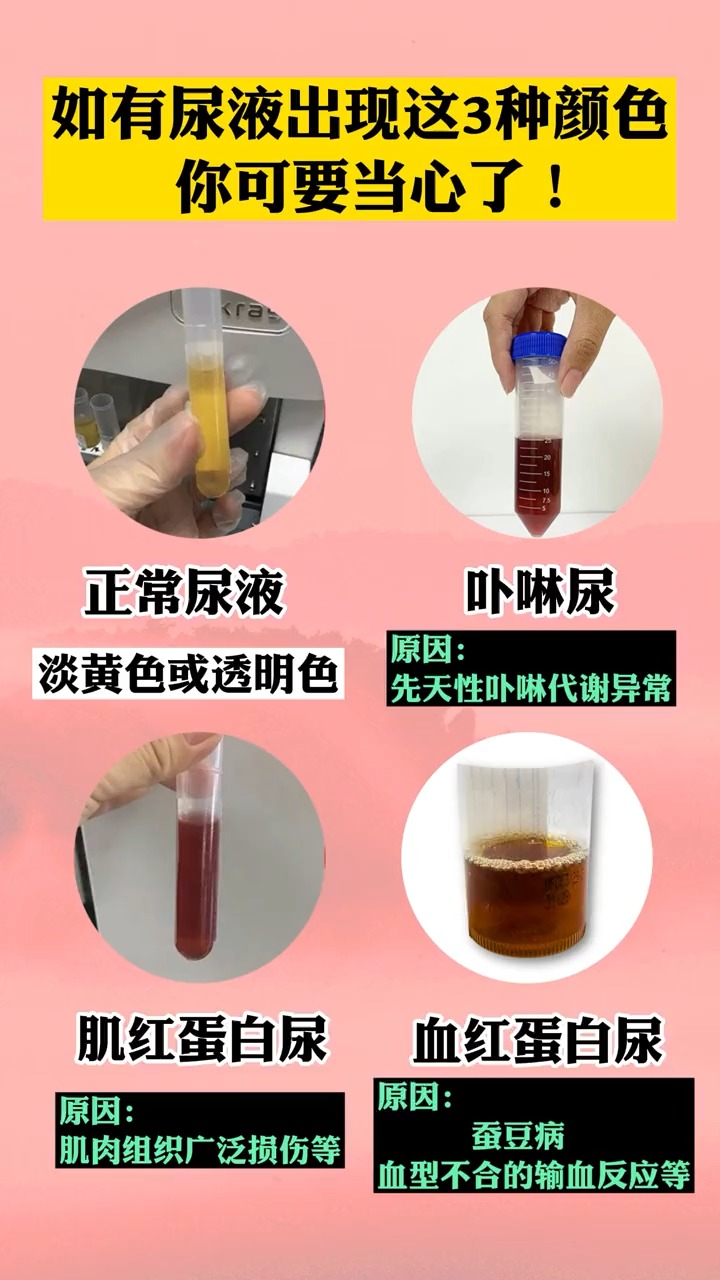 蚕豆病发病期尿液图片图片