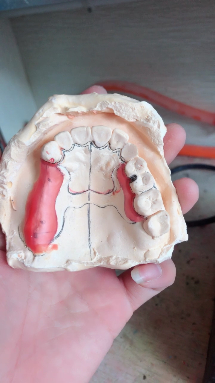 活动义齿钢托修复体设计完成啦