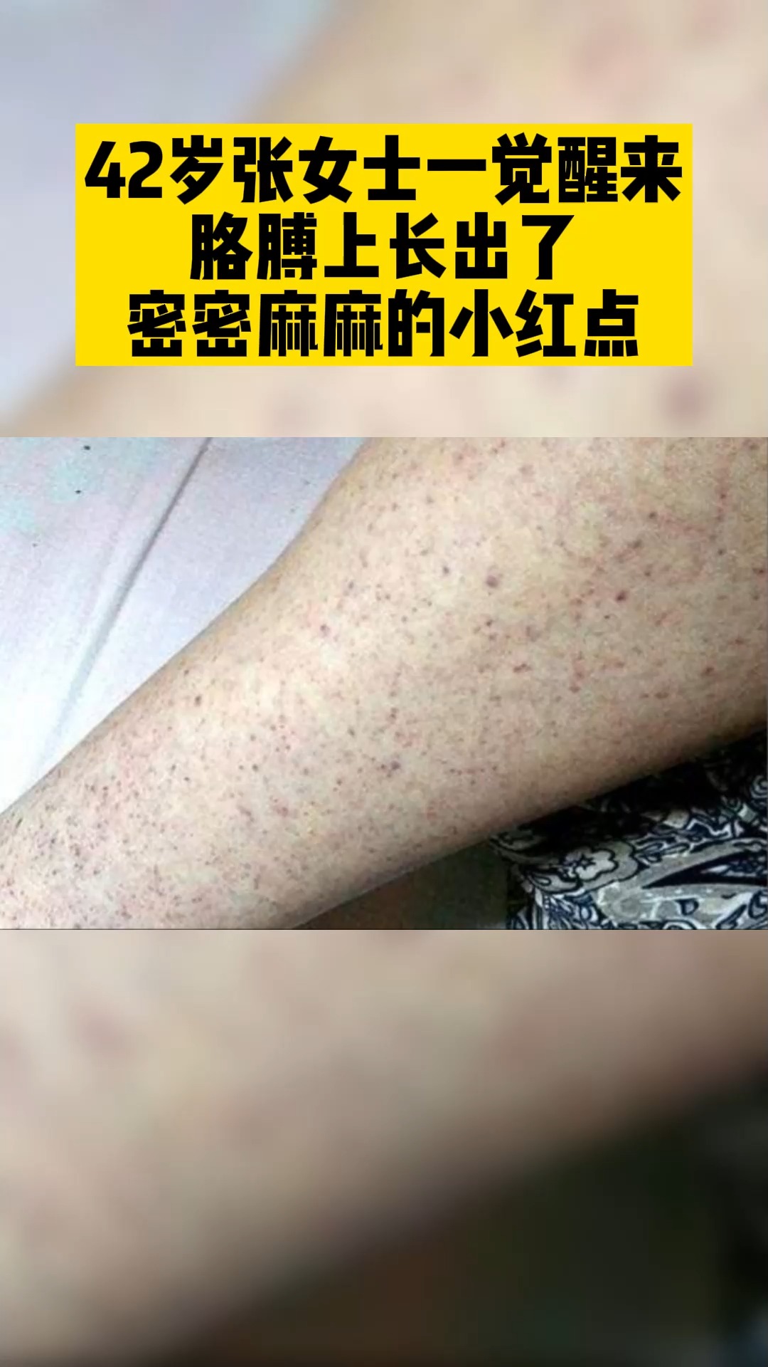 血小板#张女士皮肤突然出现红点,检查确诊为血小板减少-度小视
