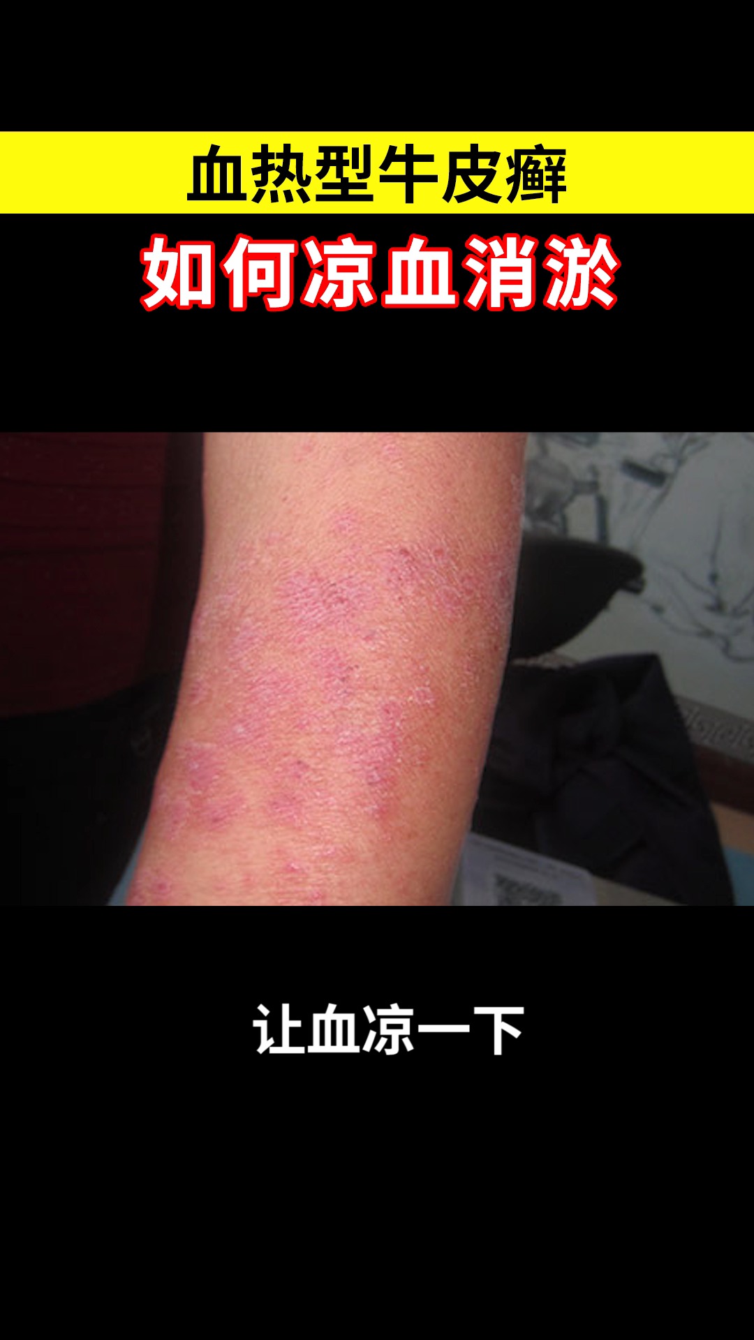 银屑病血热型牛皮癣如何凉血消淤