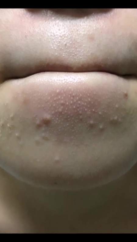 下巴有小疙瘩的姐妹真得试试这哥俩,第二天起床你会感谢我的!