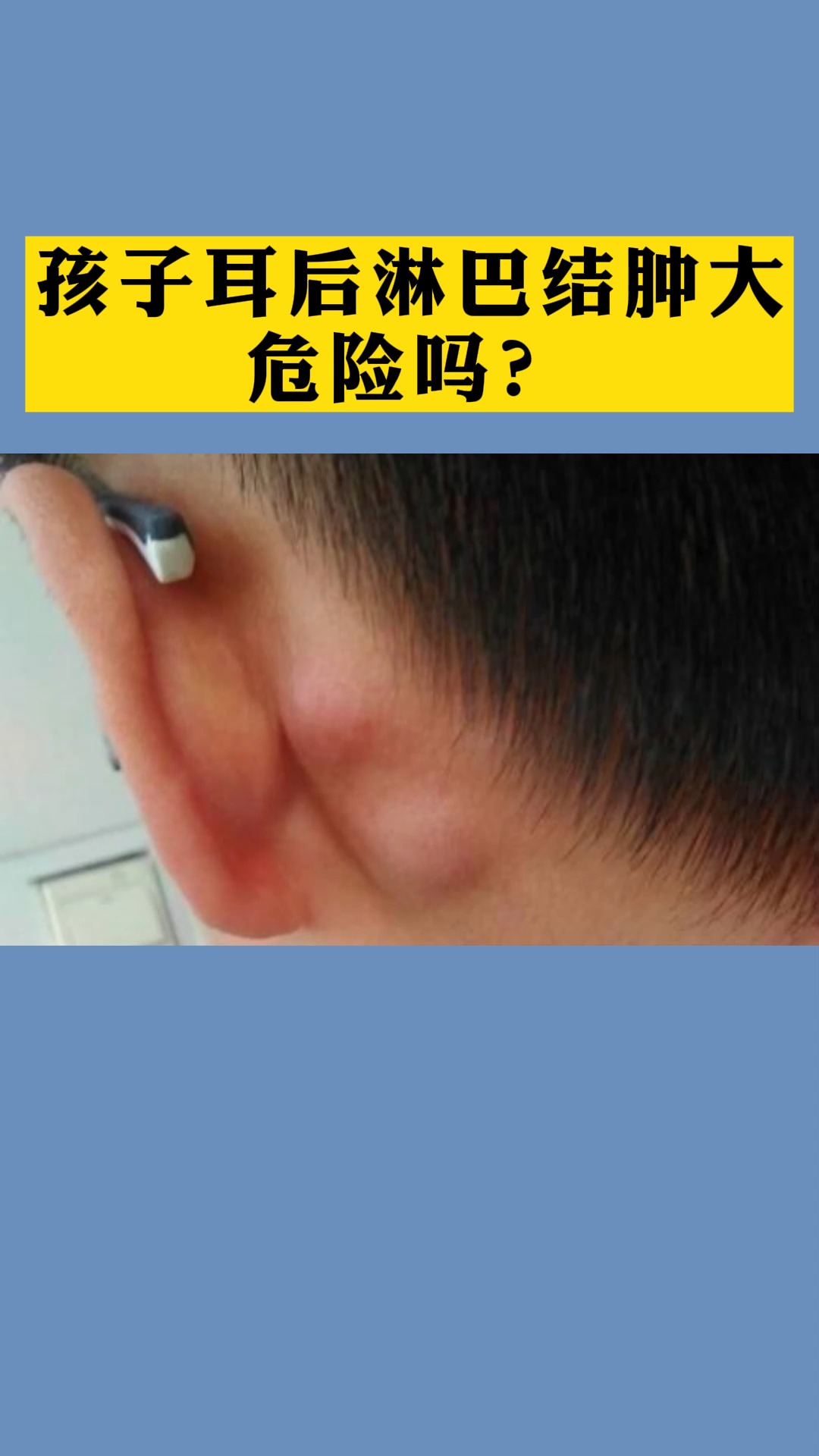 孩子耳朵后面出现淋巴结到底危险吗
