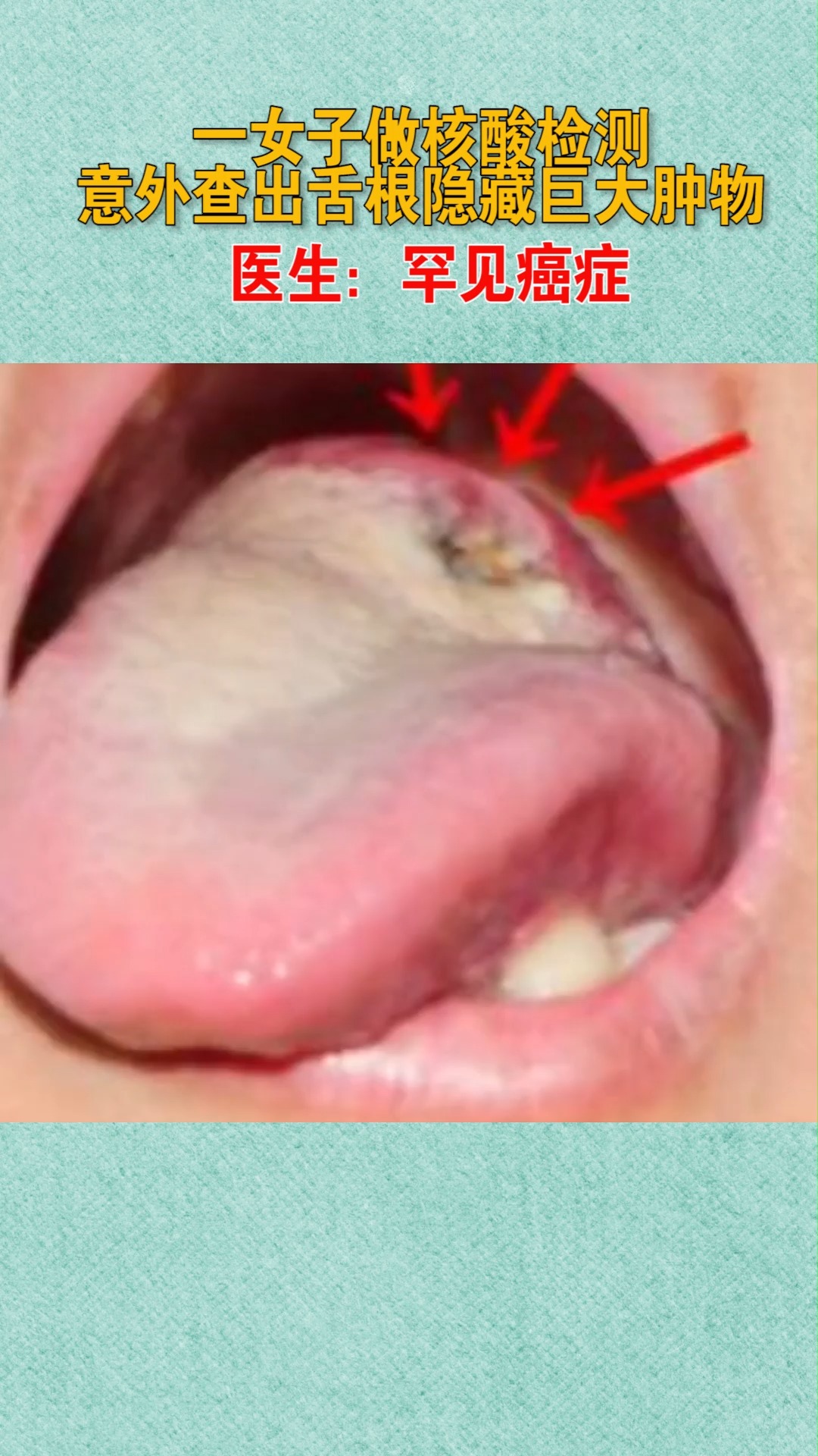 一女子做核酸检测意外查出舌根隐藏巨大肿物医生罕见癌症