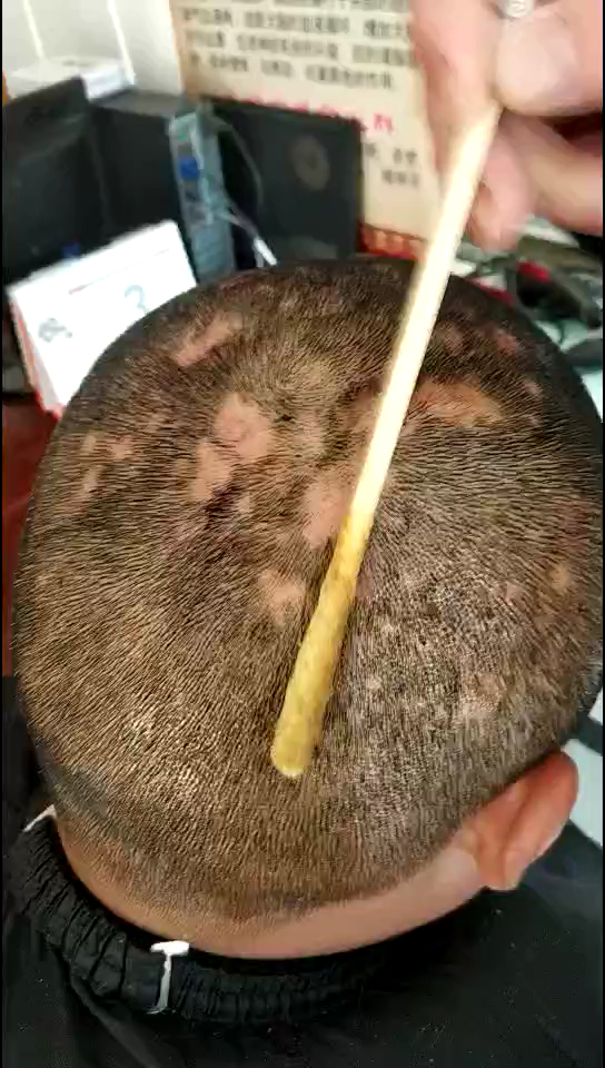 毛囊炎引起的脱发,治疗第三天,头上的脓包没有了吧!