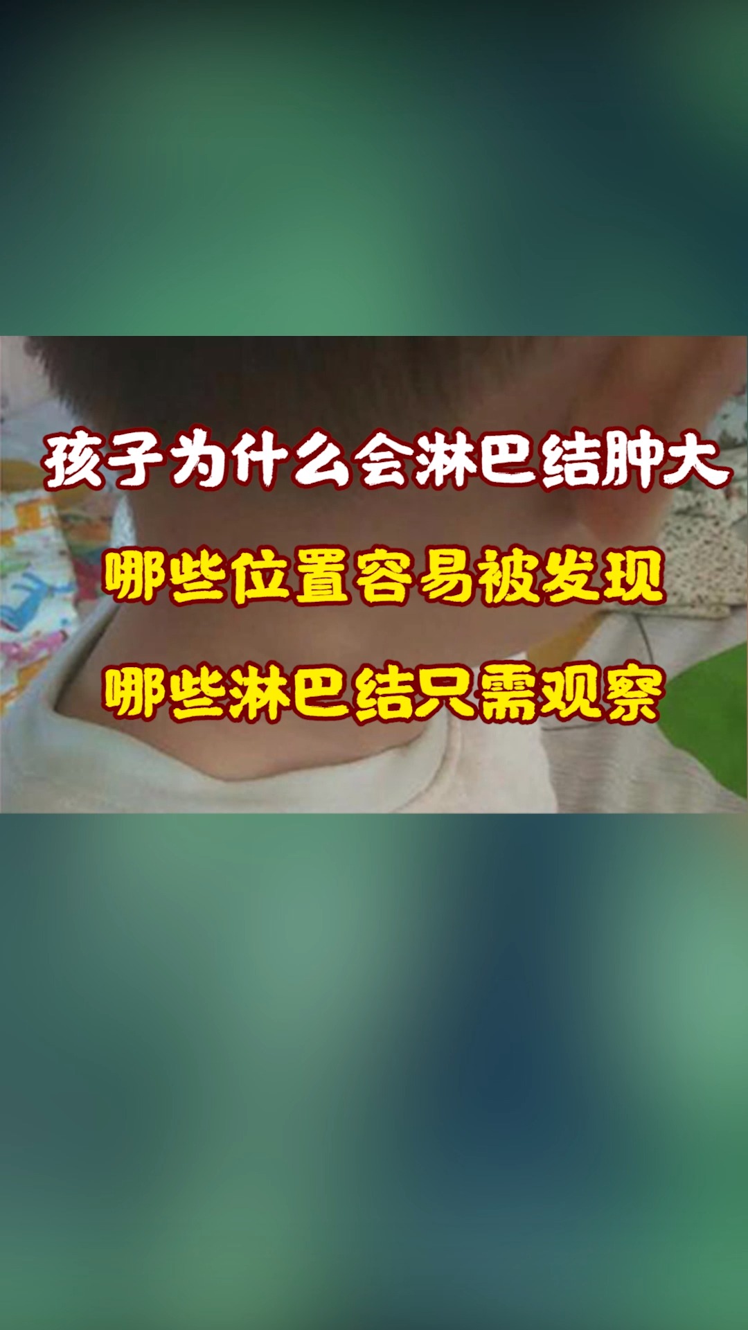 儿童淋巴结肿大须警惕图片