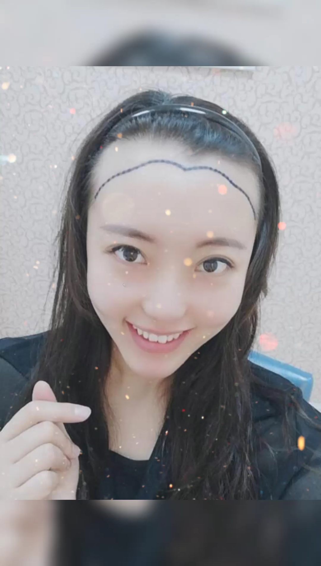 发际线#女士发际线种植