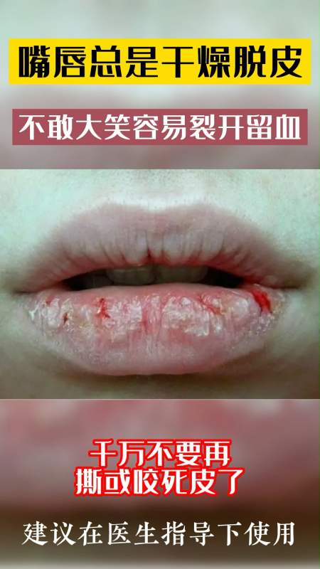夏季健康计划嘴唇总是干燥脱皮不敢大笑容易开裂流血这是剥脱性唇炎