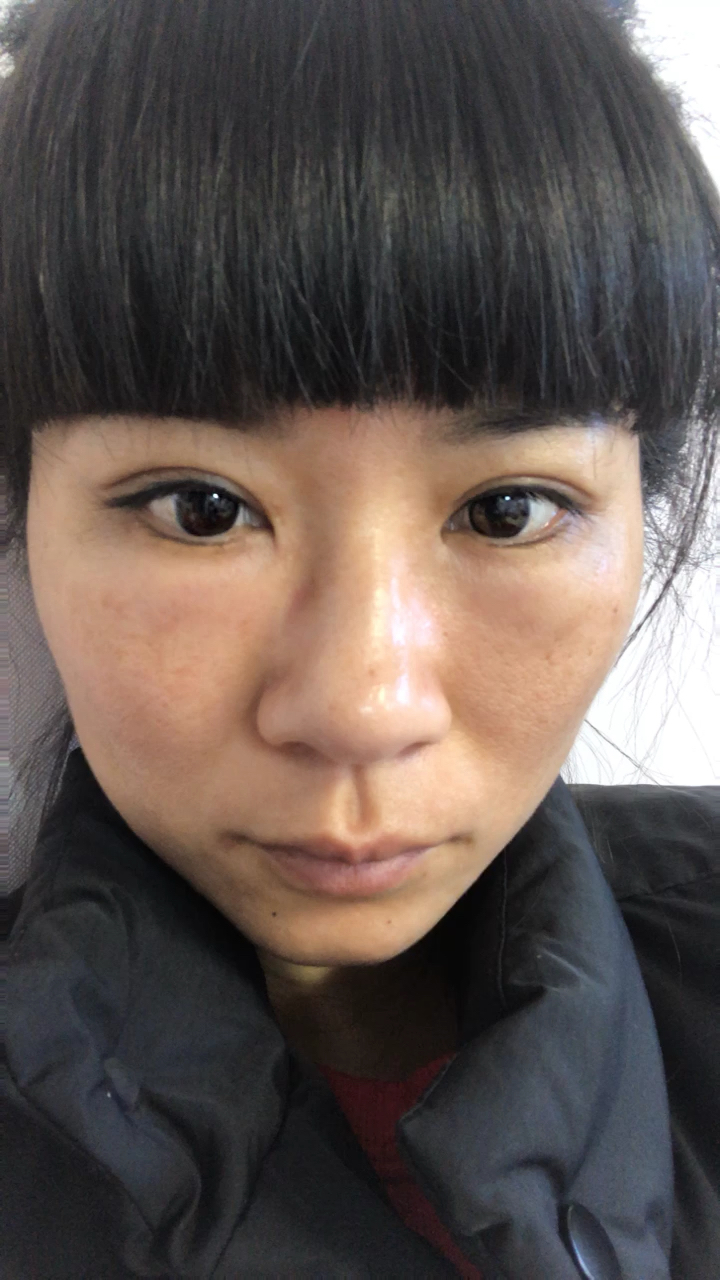 内吸眼袋第二天 肿啦