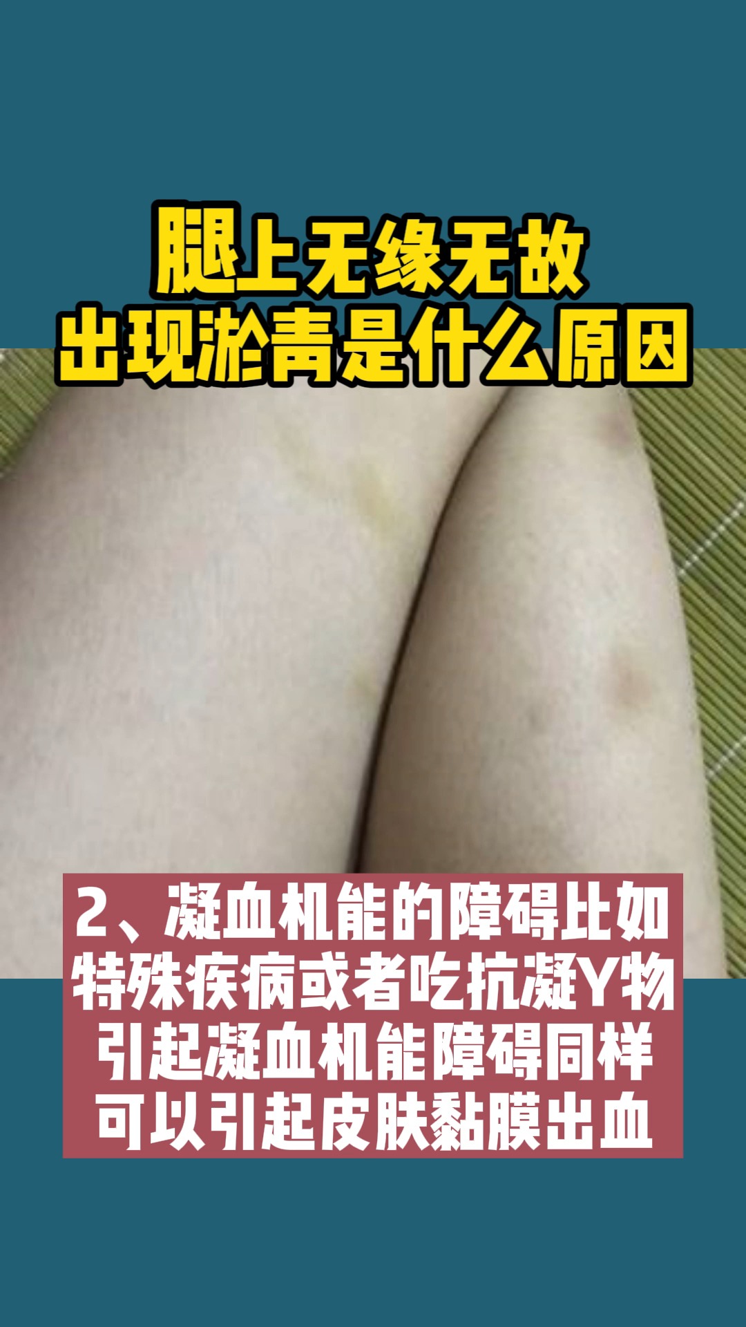 血小板减少腿上无缘无故出现淤青是什么原因