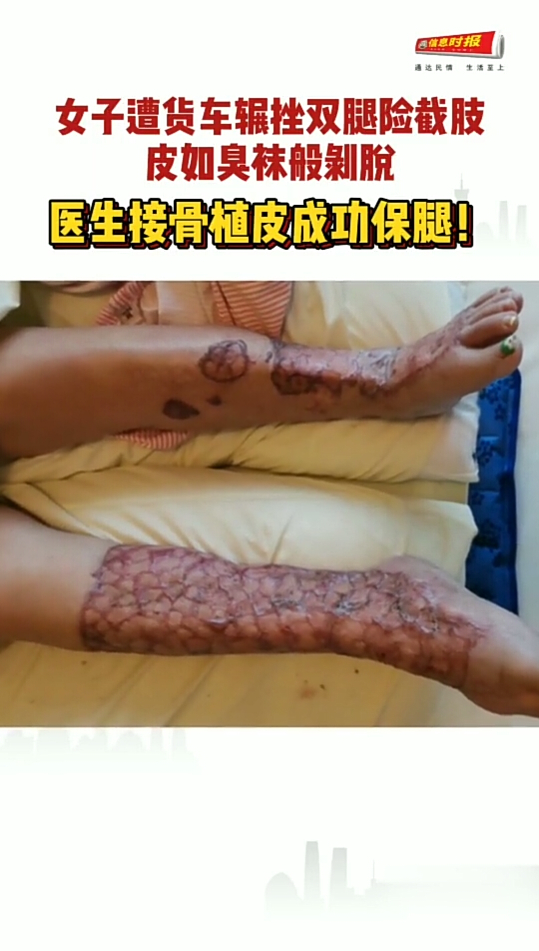 女子两腿被汽车碾压,纸皮上百块,邮票那么大,成功.