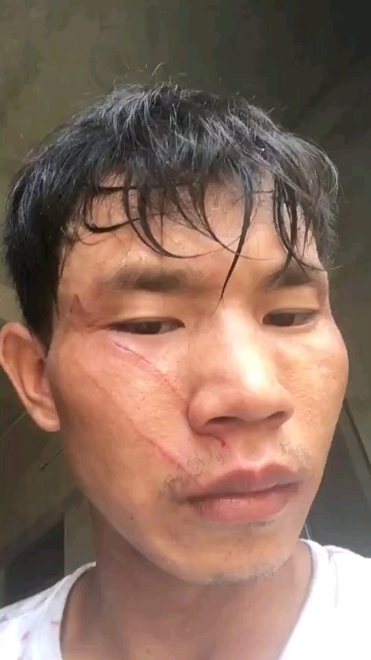 今天工地干活受伤了,这时候好想家