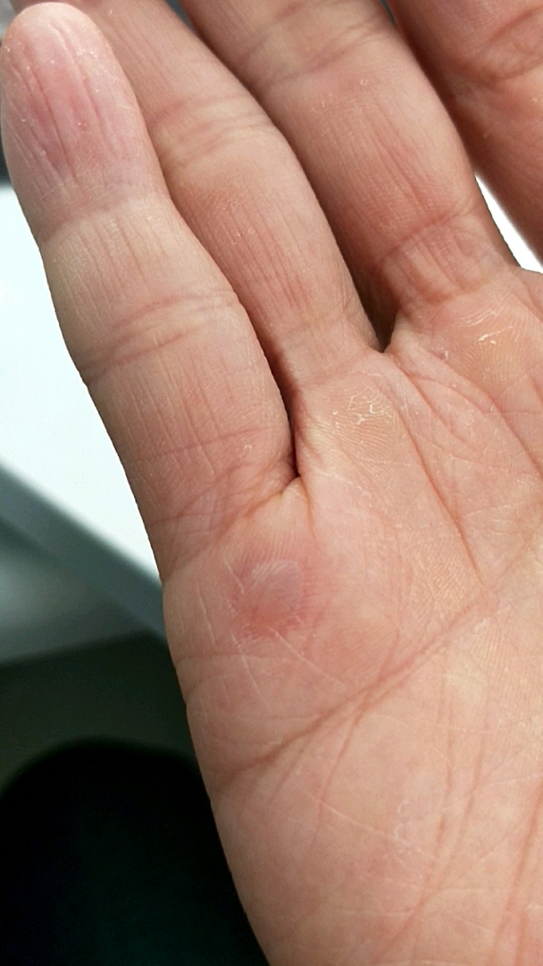 做了几组器械训练把手磨起泡了