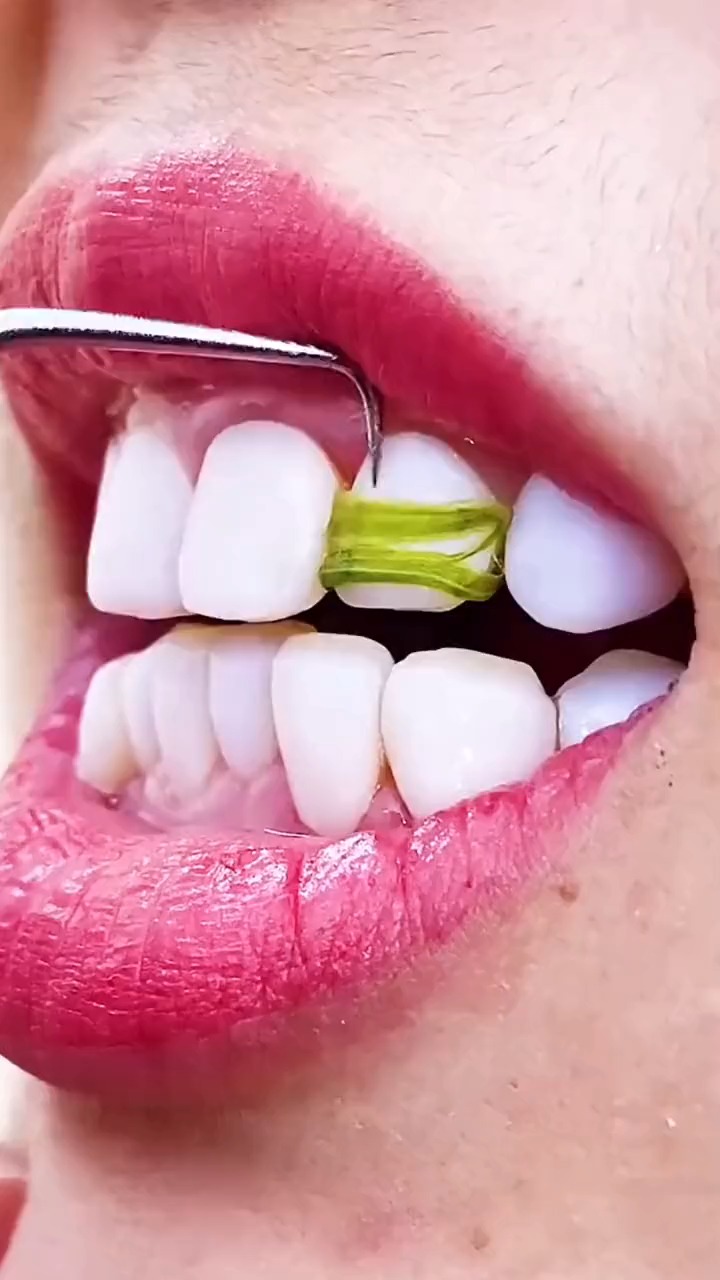 好物推荐#304不锈钢牙签随身超细牙勾缝针便携式牙签盒塞牙掏剔牙