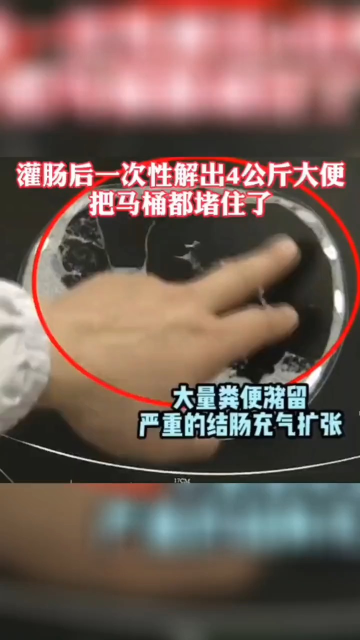 灌肠后一次性解出4公斤大便-度小视