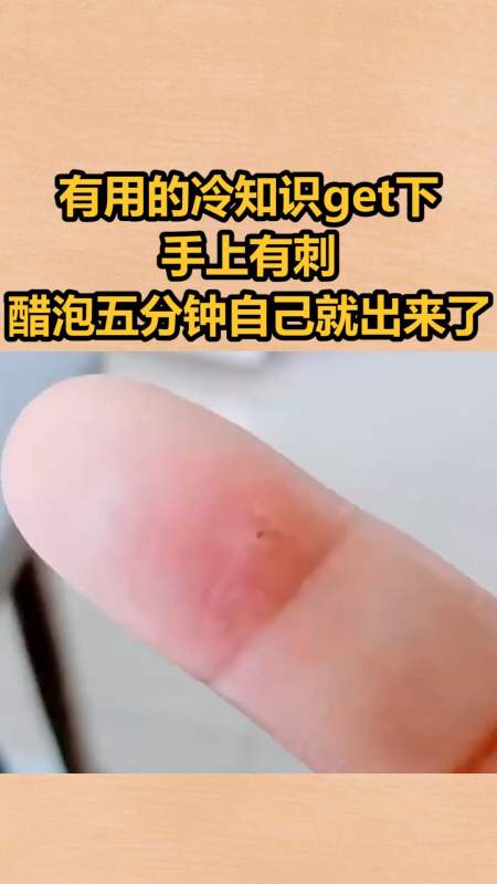 我要上熱門#有用的冷知識get下,手上有刺,醋泡五分鐘自己就出來了