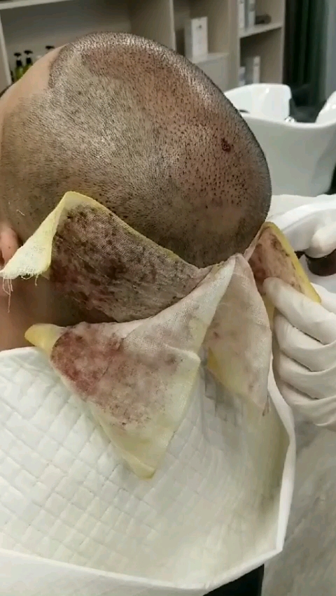 种发第二天,看着害怕,其实一点都不疼的.从此告别单身和自卑!