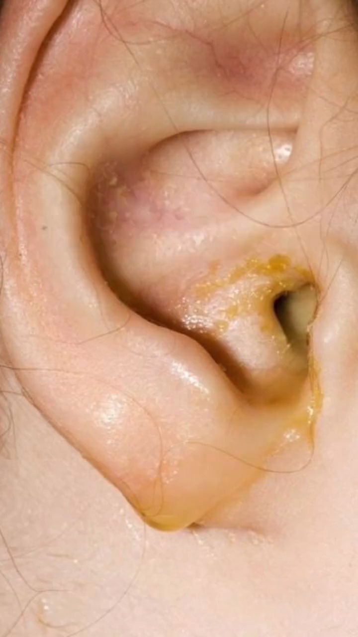 耳流脓!浙江 两位老爷子以为自己得的只是中耳炎 ……没想到差点要命!