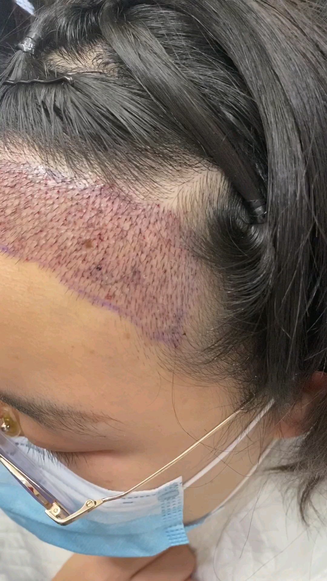 种发第二天,看着害怕,其实一点都不疼的.从此告别单身和自卑!