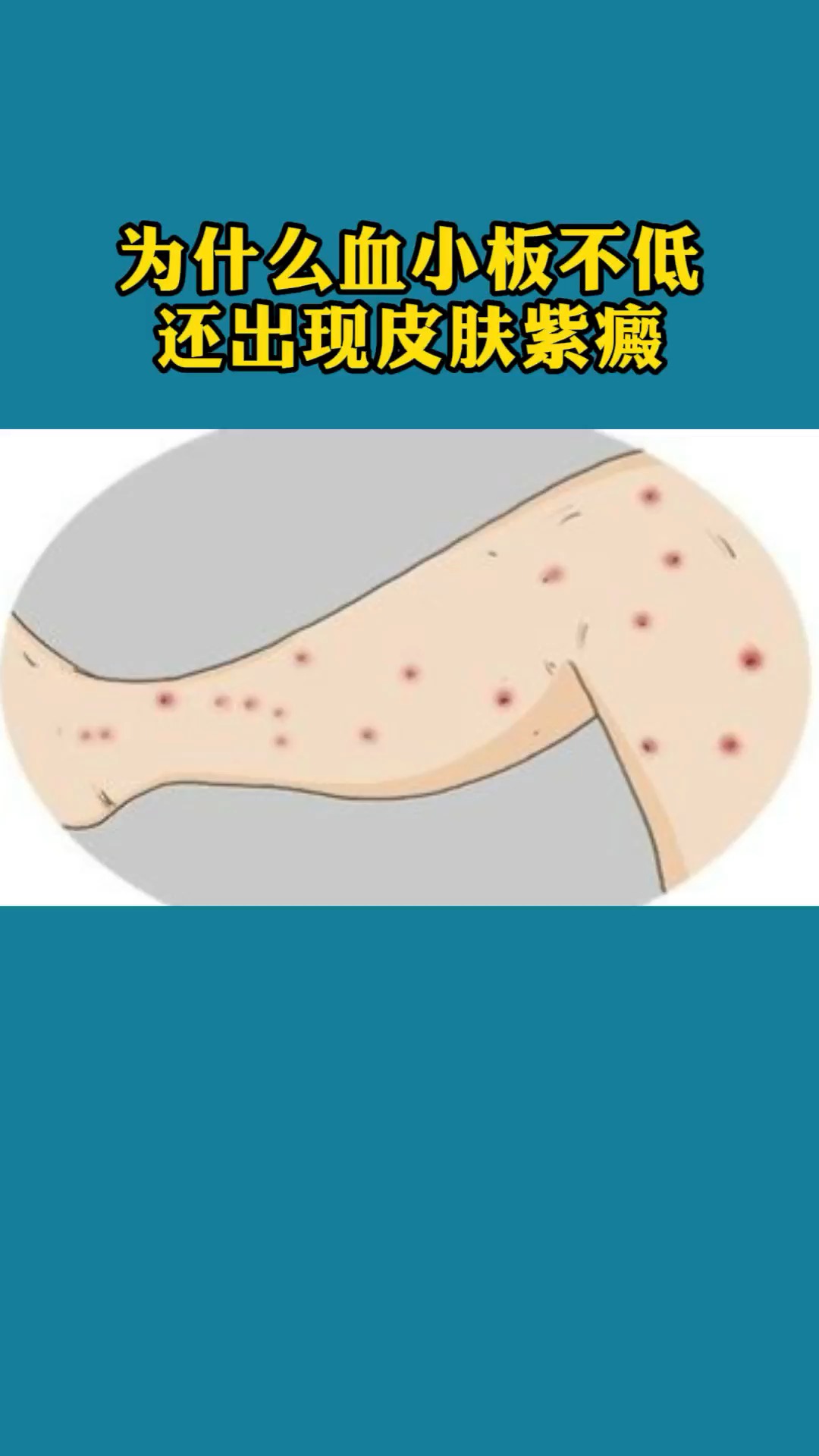 为什么血小板不低还出现皮肤紫癜