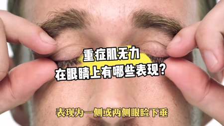 健康養生#重症肌無力在眼睛上有哪些表現?