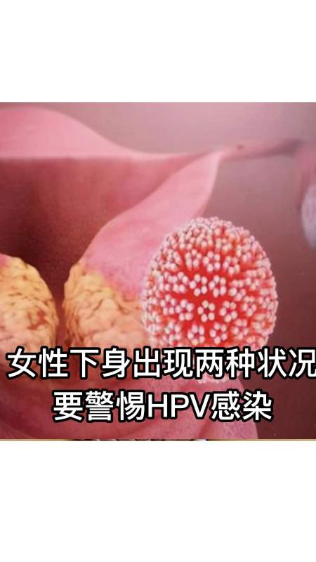 香港hpv女性下身出现两种状况要警惕hpv感染