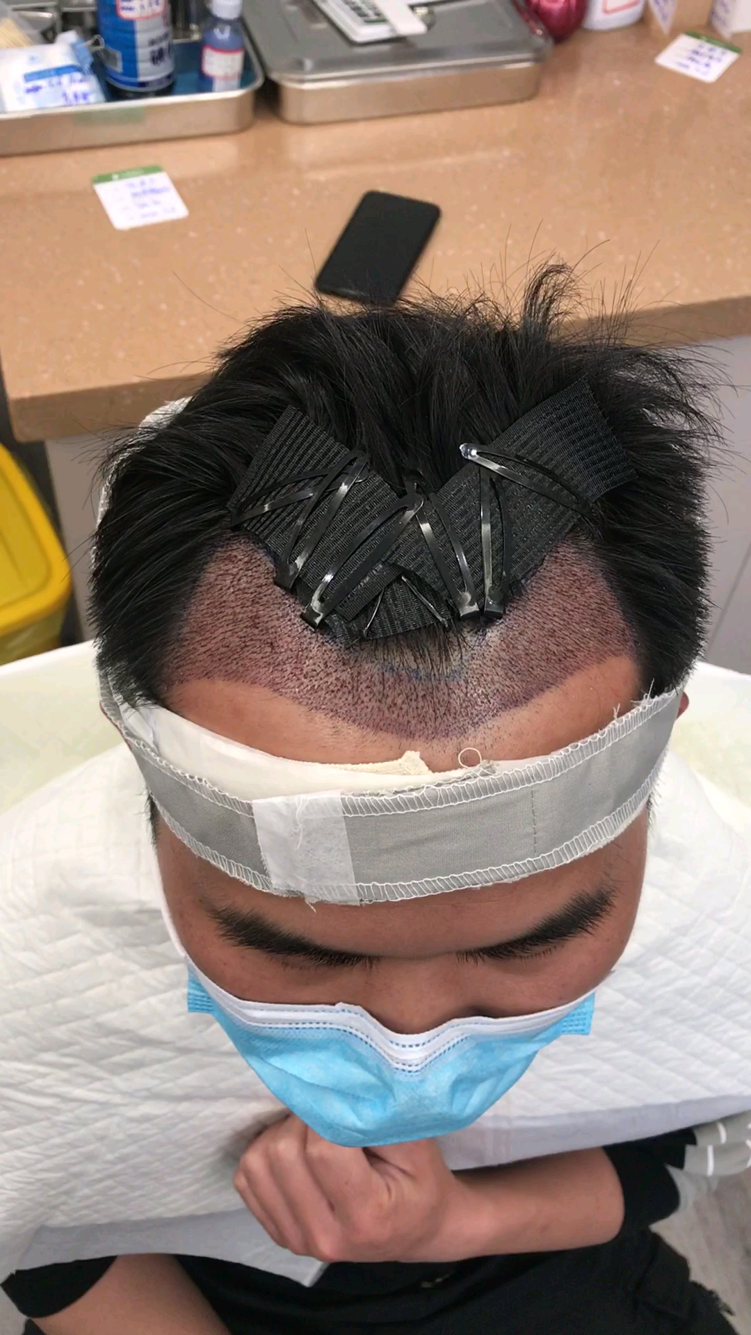 种发第二天,看着害怕,其实不疼的.从此告别单身和自卑!