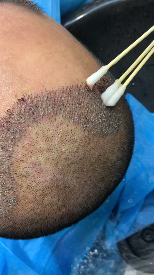 种发第二天,看着害怕,其实不疼的.从此告别单身和自卑!