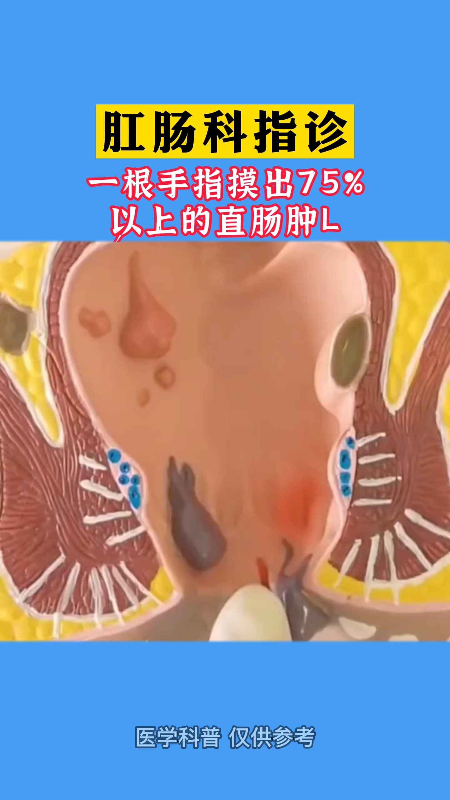 肛肠科指诊 一根手指摸出75%以上的直肠肿物