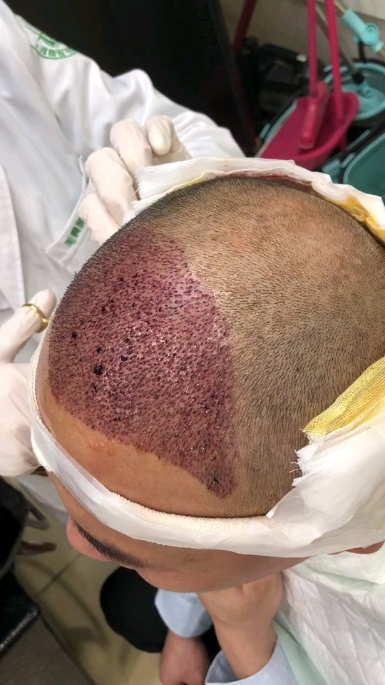 种发第二天,看着害怕,其实不疼的.从此告别单身和自卑!