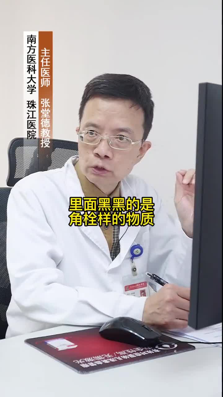 扩张孔