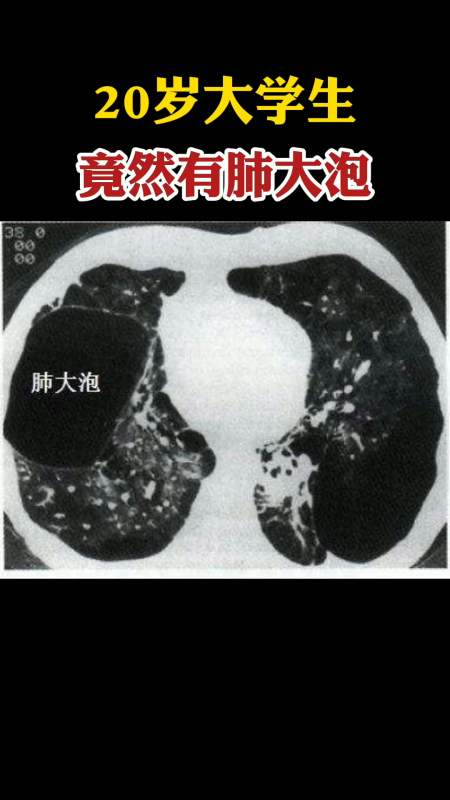 双肺尖肺大泡有危险吗图片