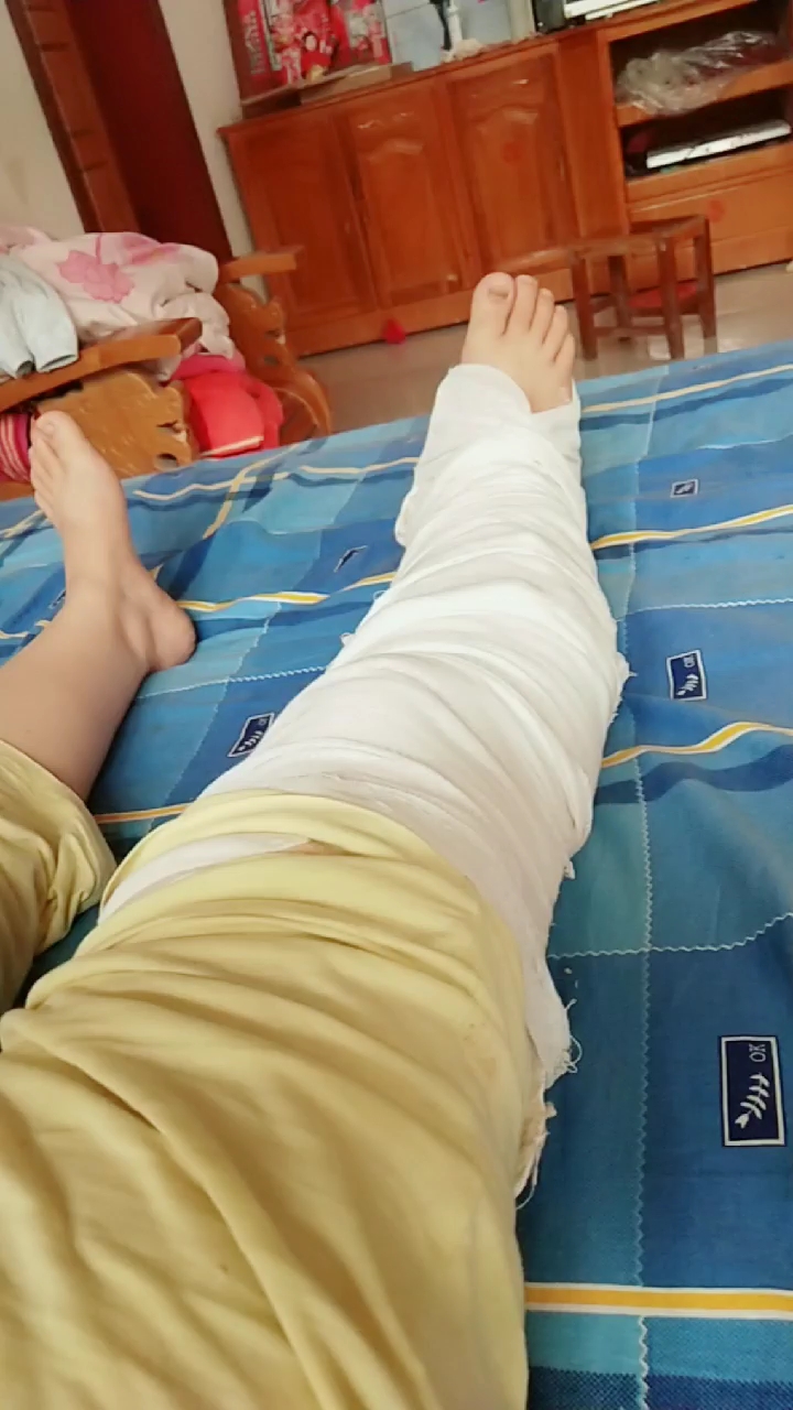 宝宝五个月了还有俩大宝,一天忙的像个陀螺,腿骨折了,只能在家养着